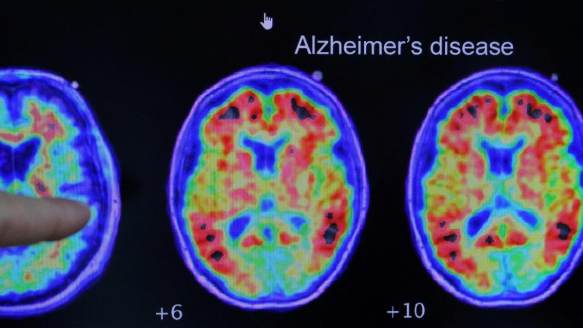 Not recalling dreams may signal early Alzheimer’s risk: study